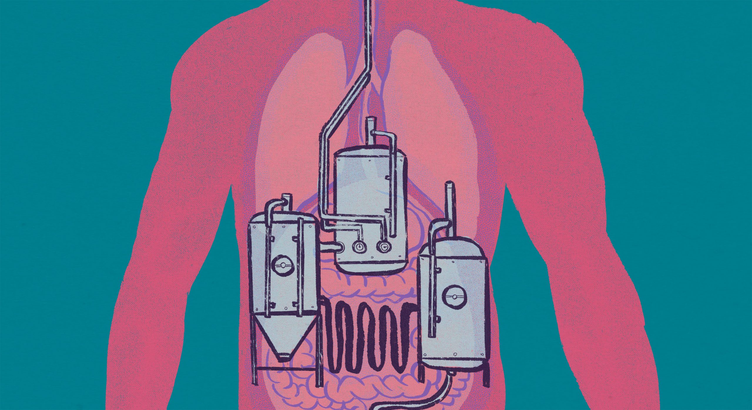 auto-brewery-syndrome